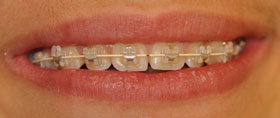 brackets céramiques
